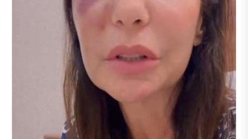 Ivete Sangalo fala sobre cirurgia que fez no rosto após queda no banheiro: ‘Houve uma ruptura de osso’