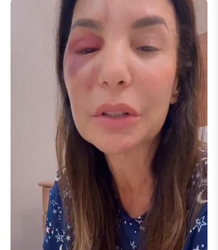 Ivete Sangalo fala sobre cirurgia que fez no rosto após queda no banheiro: ‘Houve uma ruptura de osso’